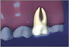 root canals