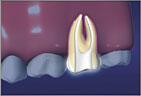 root canals