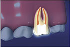 root canals