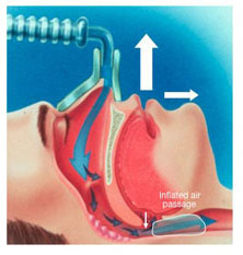 Continuous positive airway pressure