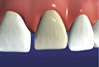 veneers 1