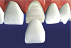 veneers 3