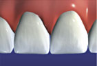 veneers 4